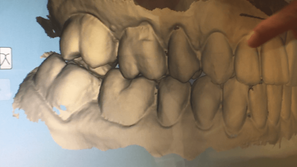 blizzident toothbrush dental 3D scan calgary family braces