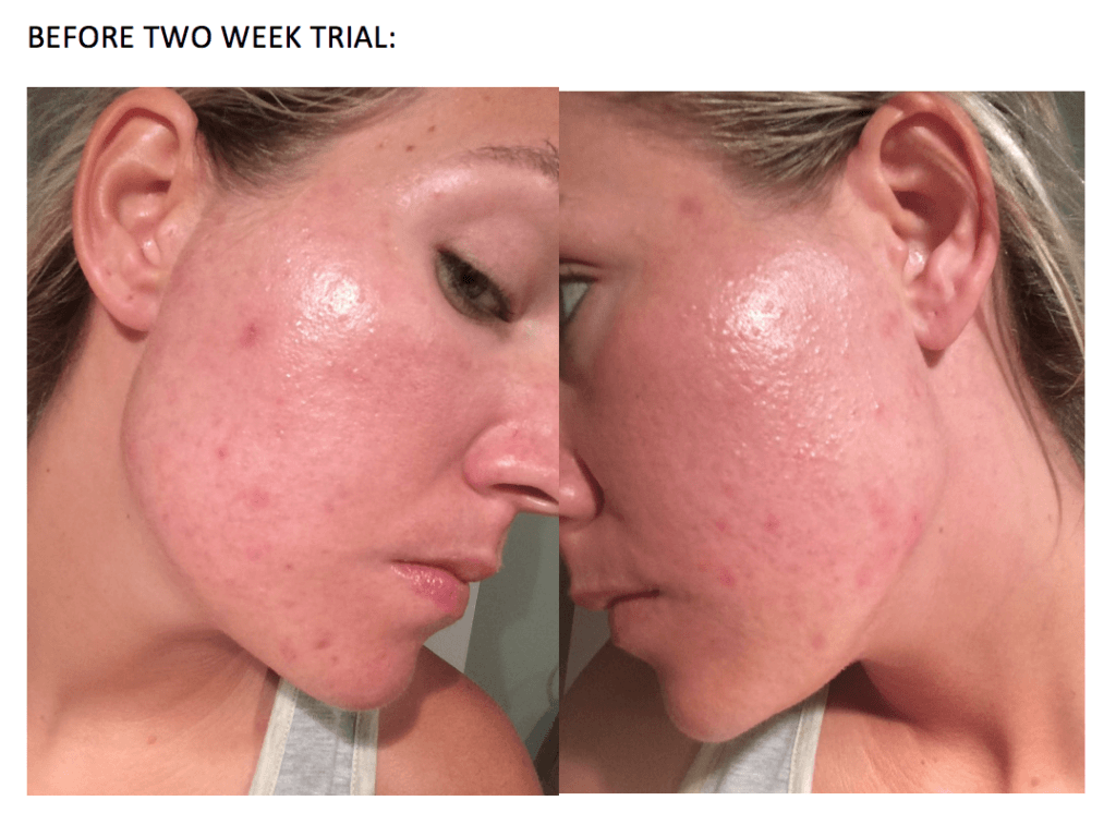 Foreo espada blue light laser led acne zit treatment